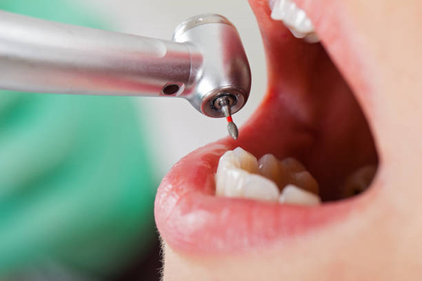Best Emergency Treatment for Dental Infections or Abscesses in Cartervle, IL